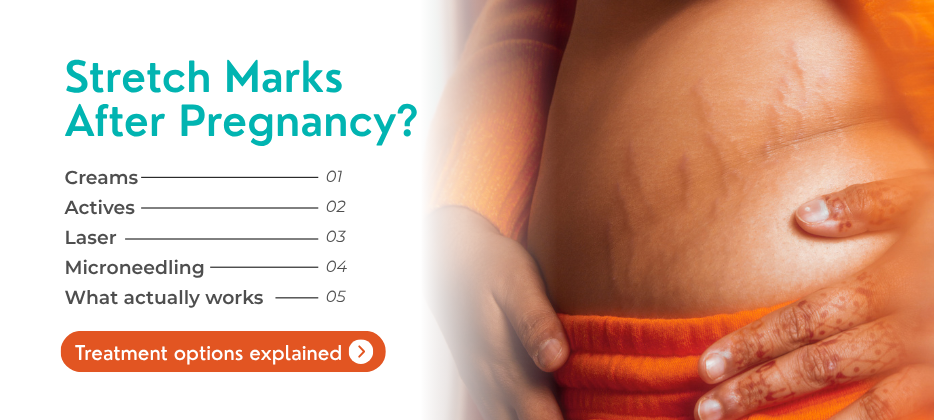 Post-Pregnancy Stretch Marks: Treatments That Actually Work