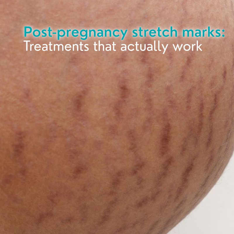 Post-Pregnancy Stretch Marks: Treatments That Actually Work