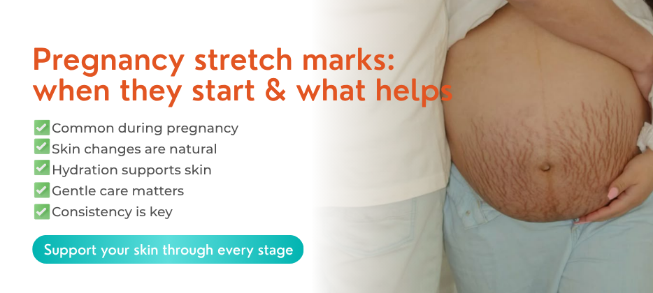 When Do Stretch Marks Start in Pregnancy and How to Treat Them