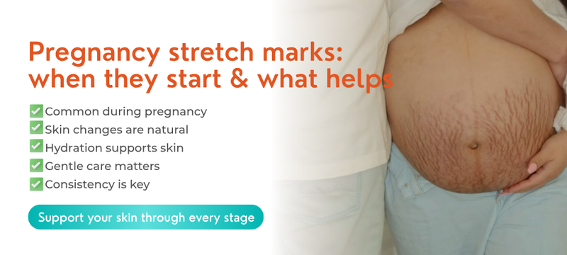When Do Stretch Marks Start in Pregnancy and How to Treat Them