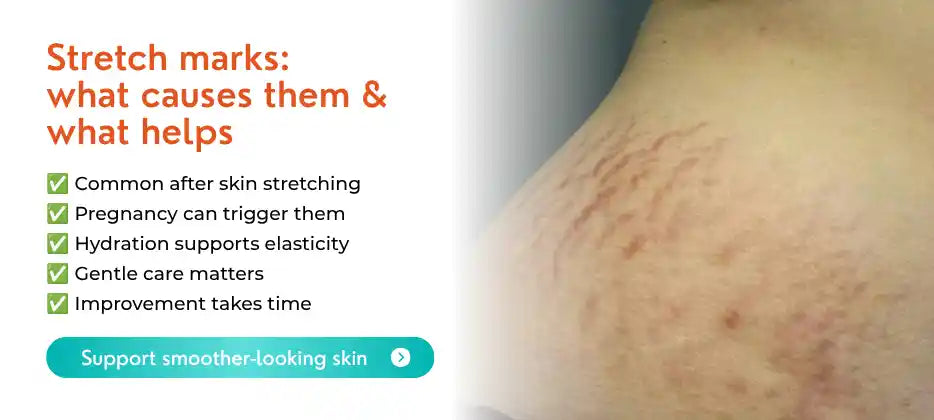Understanding Stretch Marks: What Causes Them and What Helps Over Time
