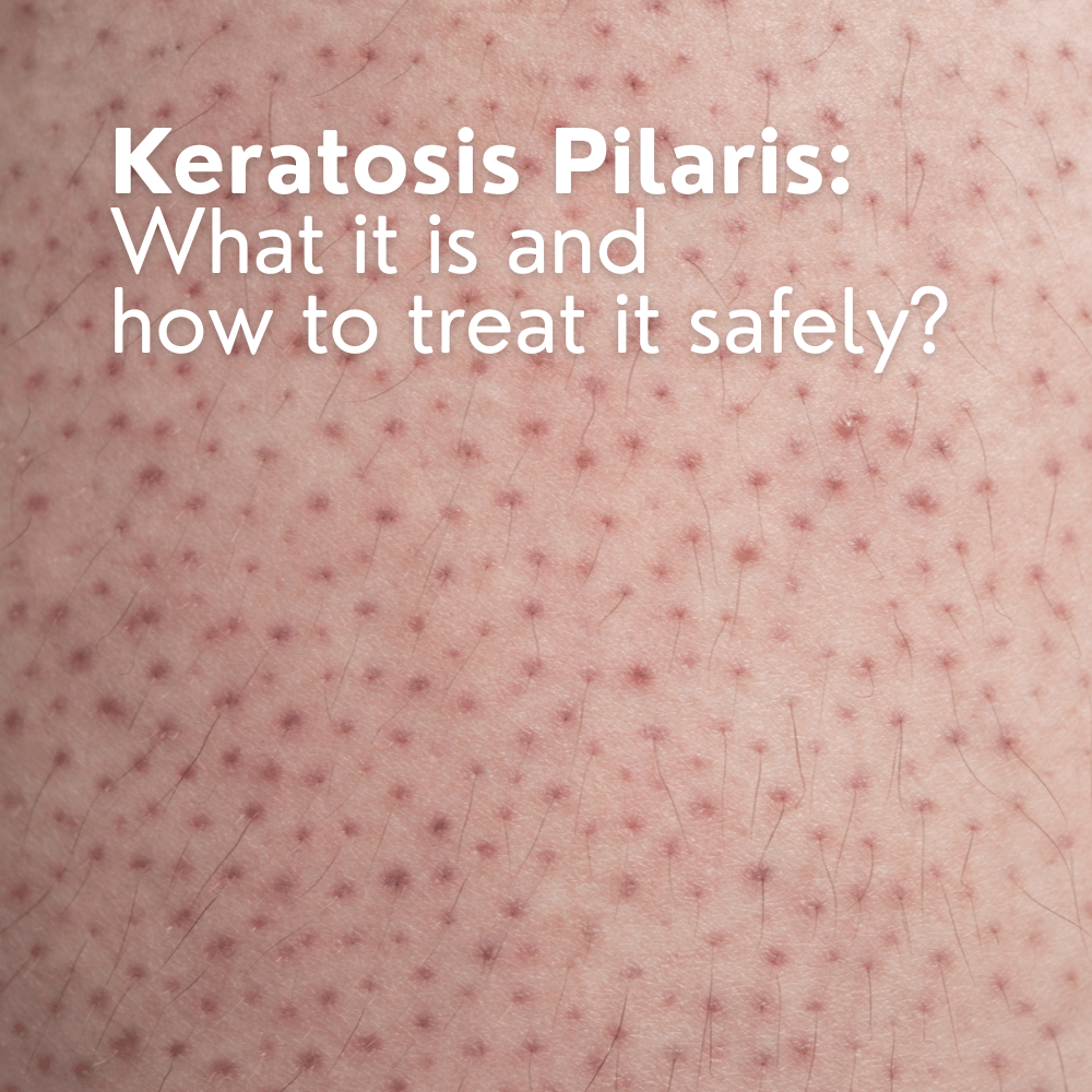 Keratosis Pilaris: What It Is and How to Treat It Safely
