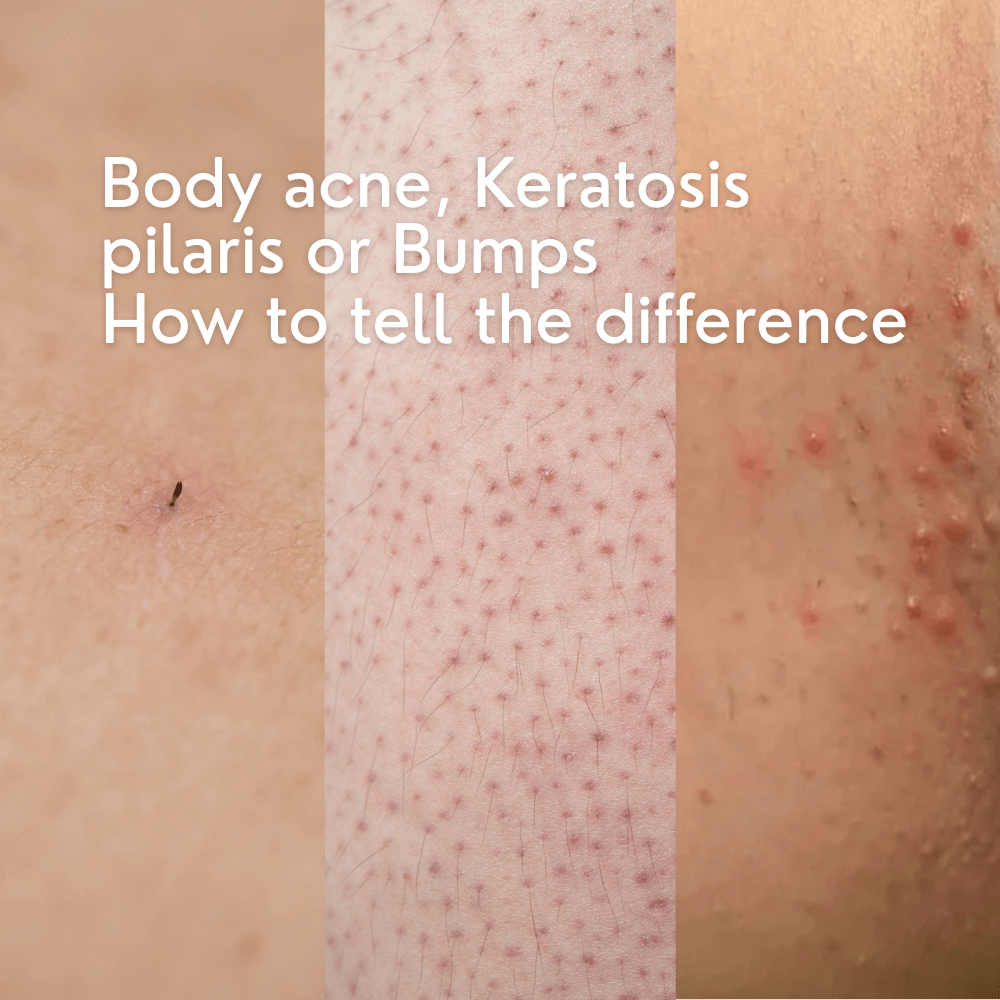 Body Acne, Keratosis Pilaris, or Bumps: How to Tell the Difference
