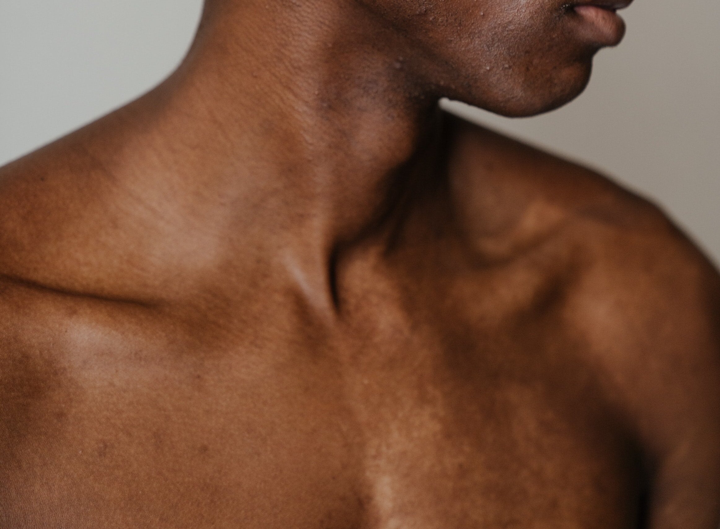 how to treat hyperpigmentation