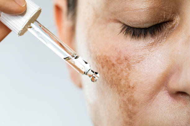 Say Bye-Bye to Pigmentation with these actives
