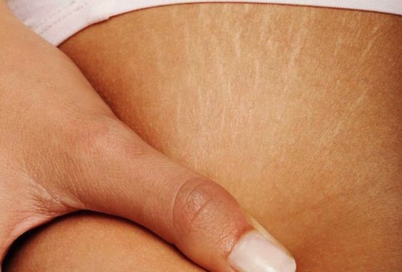 how to get rid of stretchmarks