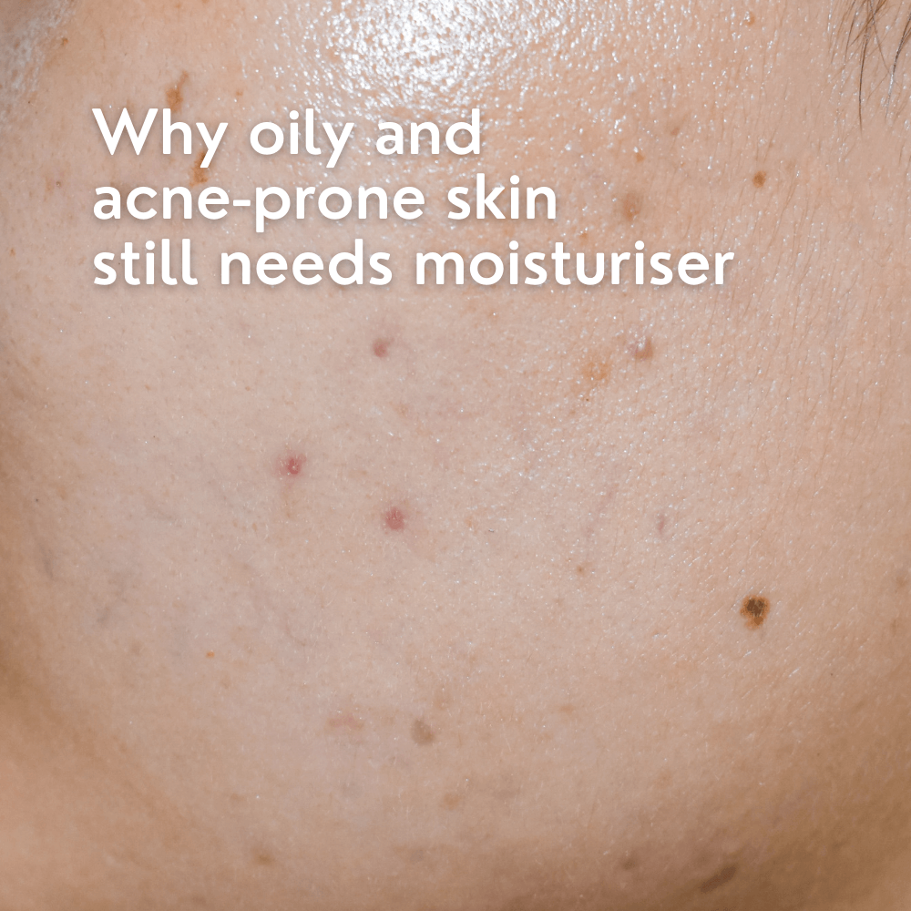 Why Oily and Acne-Prone Skin Still Needs Moisturiser