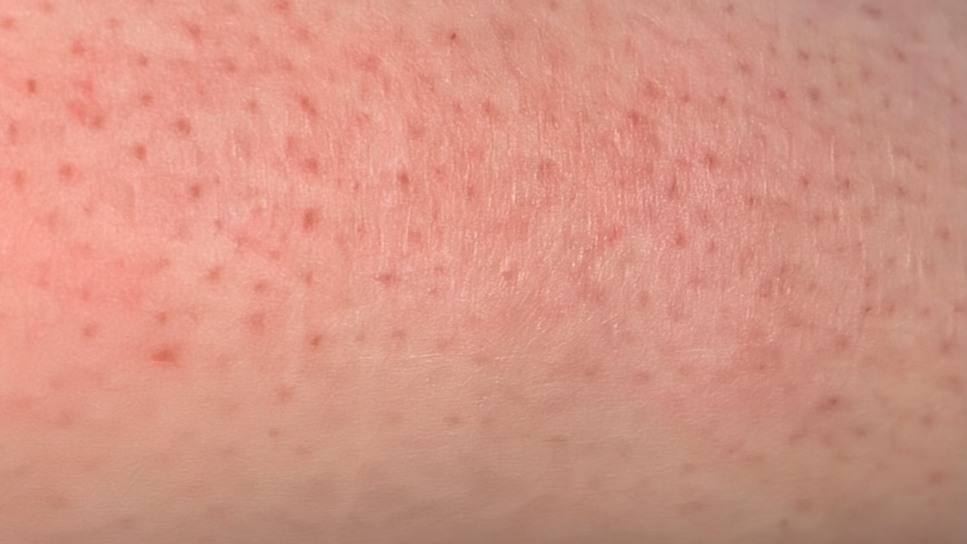 Close-up of skin with red spots