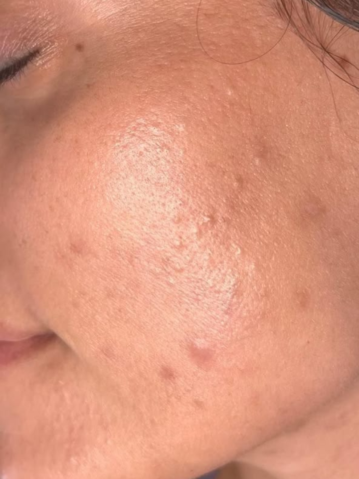Close-up of a person's forehead with visible skin texture and pores.