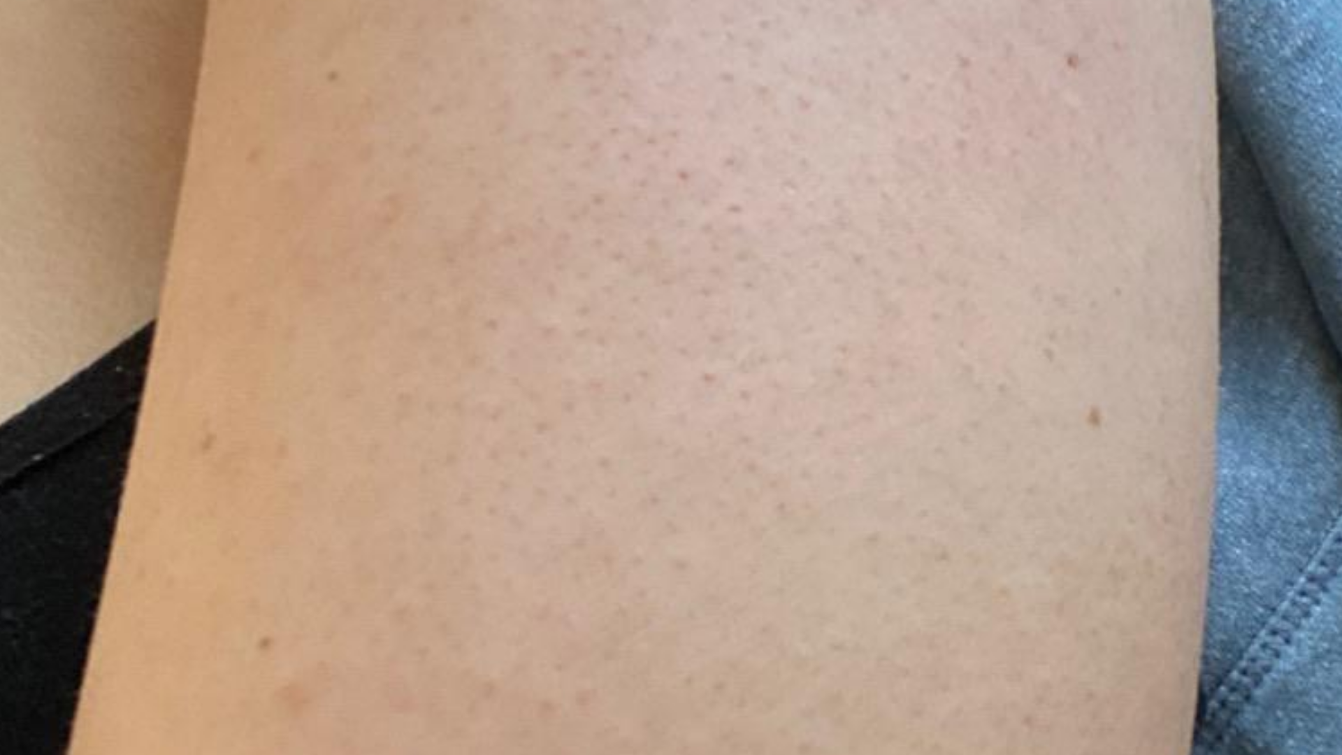 Bye bye bumps - Exfoliating Mist For ingrowns, keratosis pilaris, bumps ...