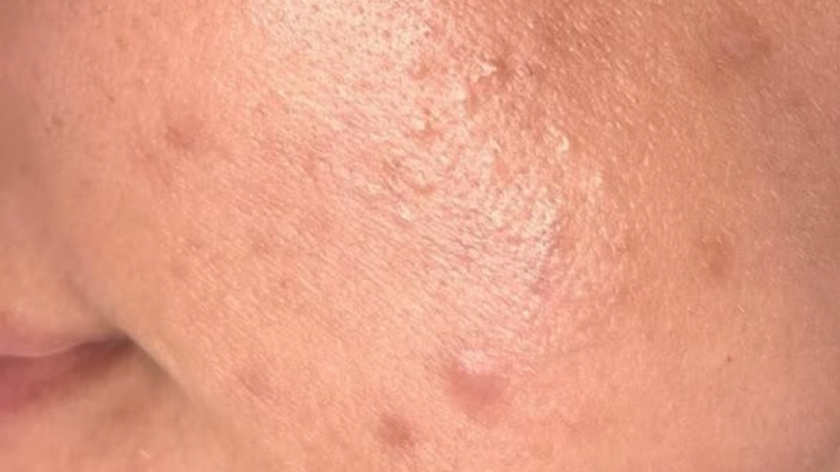 Close-up of skin with visible blemishes and pores