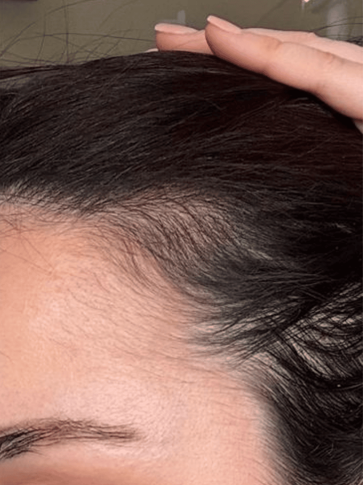 Close-up of a person's head with dark hair, showing the hairline.