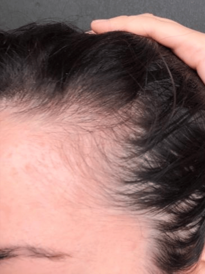 Close-up of a person's head with hair loss visible on the scalp.