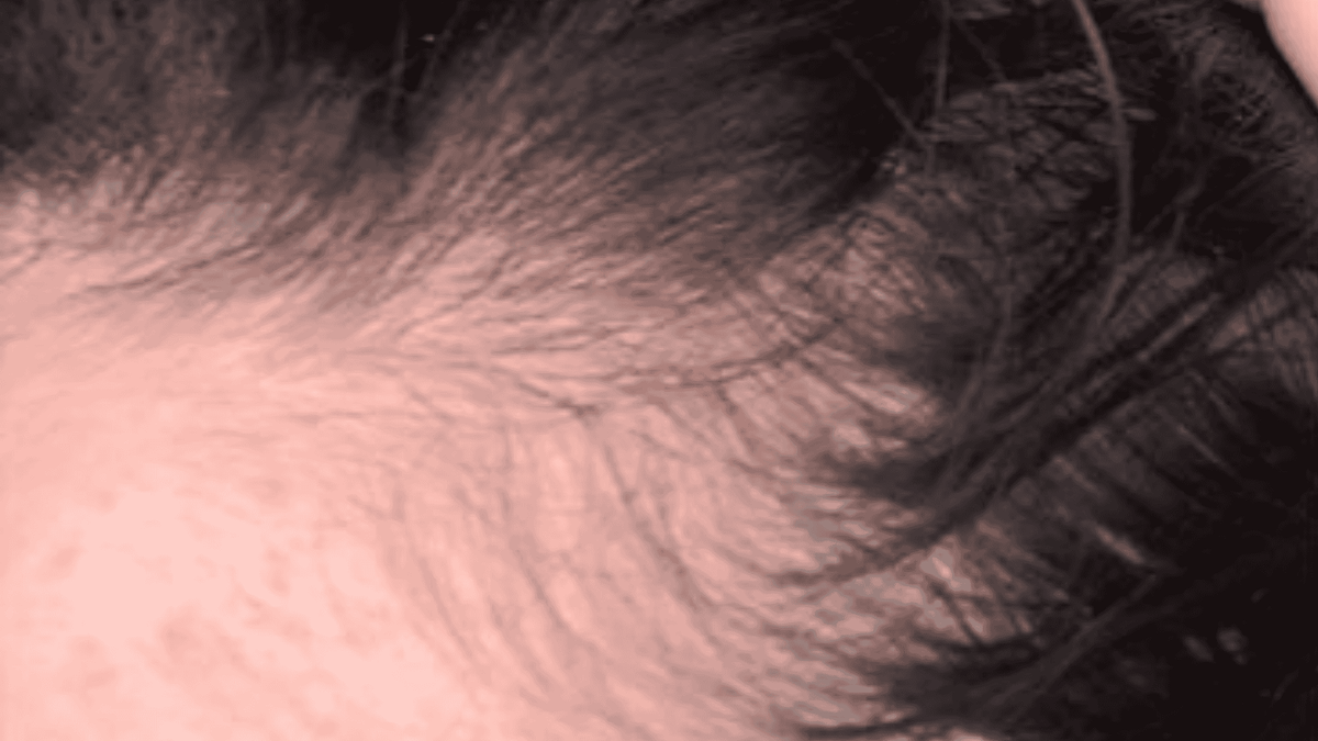 Close-up of a person's scalp with thinning hair