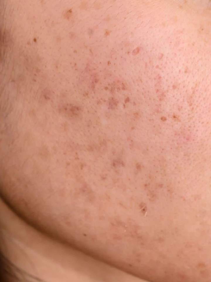 Close-up of a person's shoulder with visible skin texture and pores.