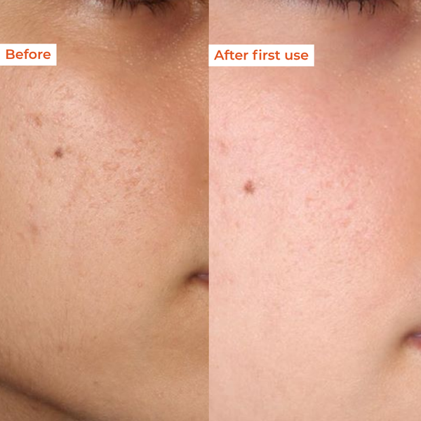 Resurface  Anti-tan peeling gel