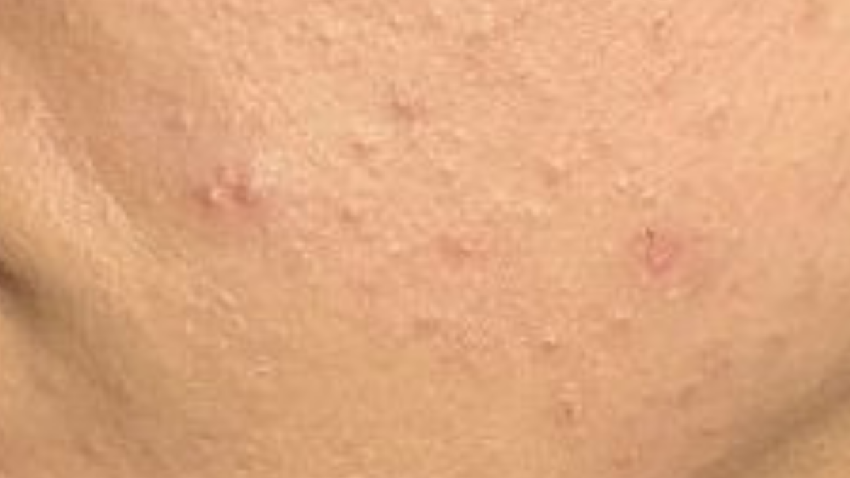 Close-up of skin with visible pores and slight redness