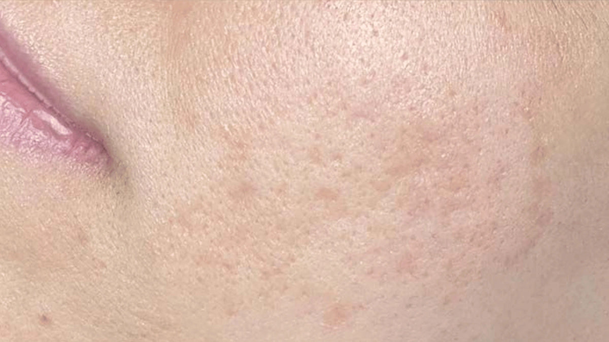 Close-up of skin texture with a focus on pores and surface details.