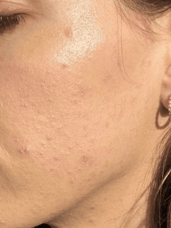 Close-up of a person's face with visible skin texture and pores.