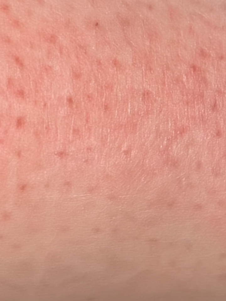 Close-up of skin with small red spots