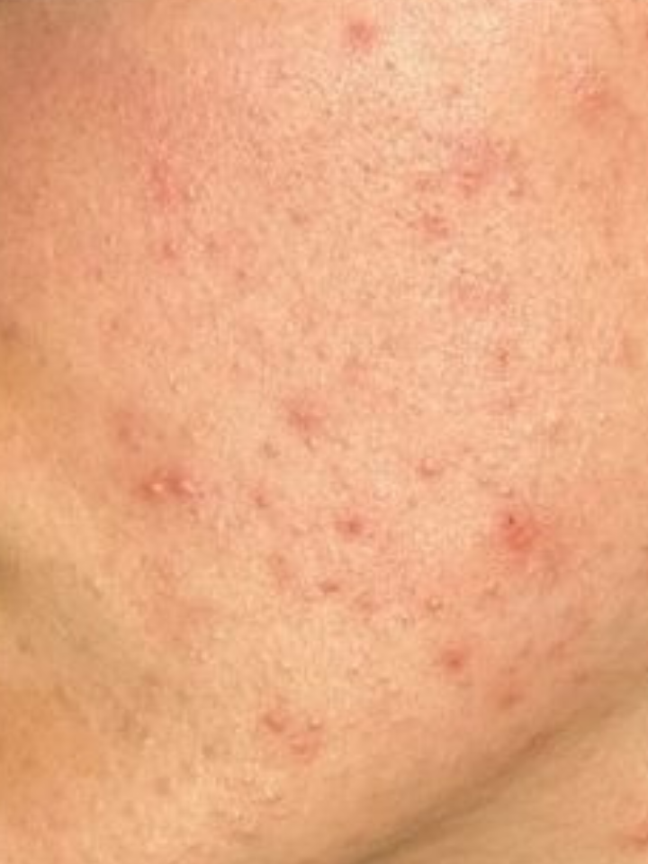 Close-up of skin with small red spots