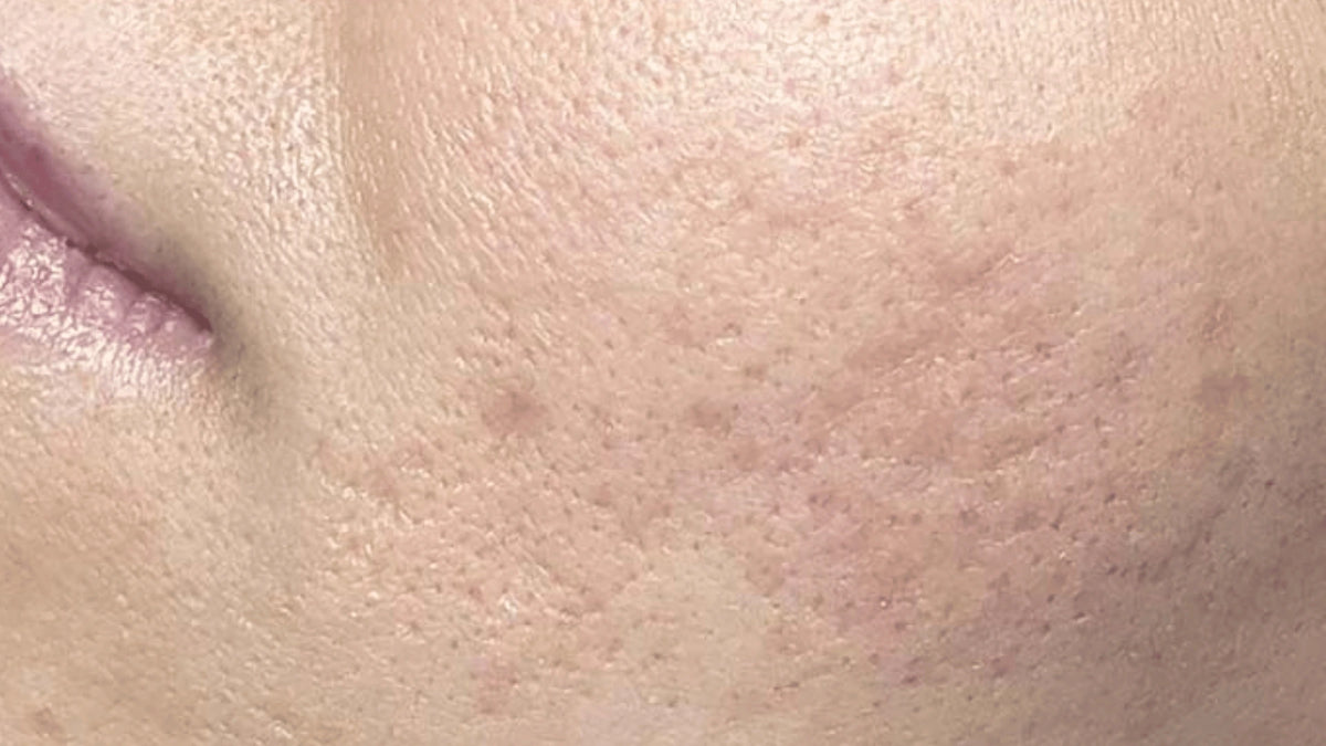 Close-up of skin texture with visible pores and slight discoloration.