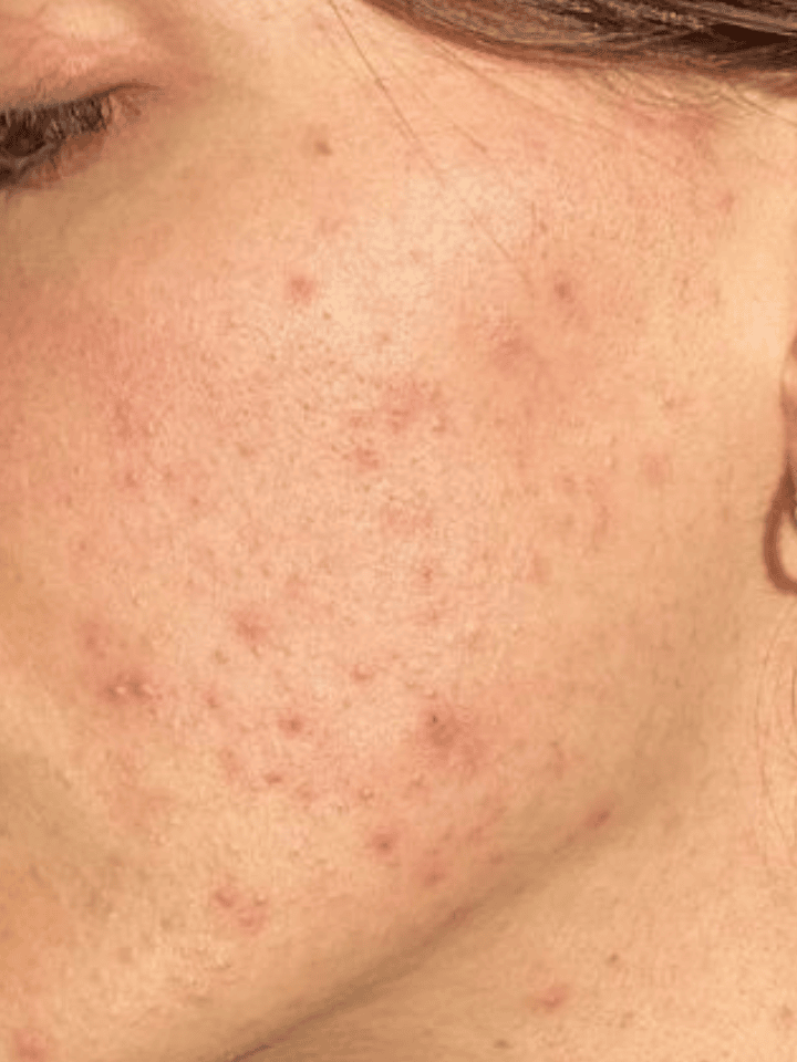Close-up of a person's face with visible acne on the skin.