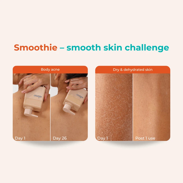 Skinvest Smoothie Body Conditioner – visible improvement in body acne by day 26 and hydration of dry, flaky skin after one use